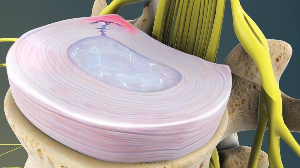 Risse/Spalte in der Außenschicht des Faserrings