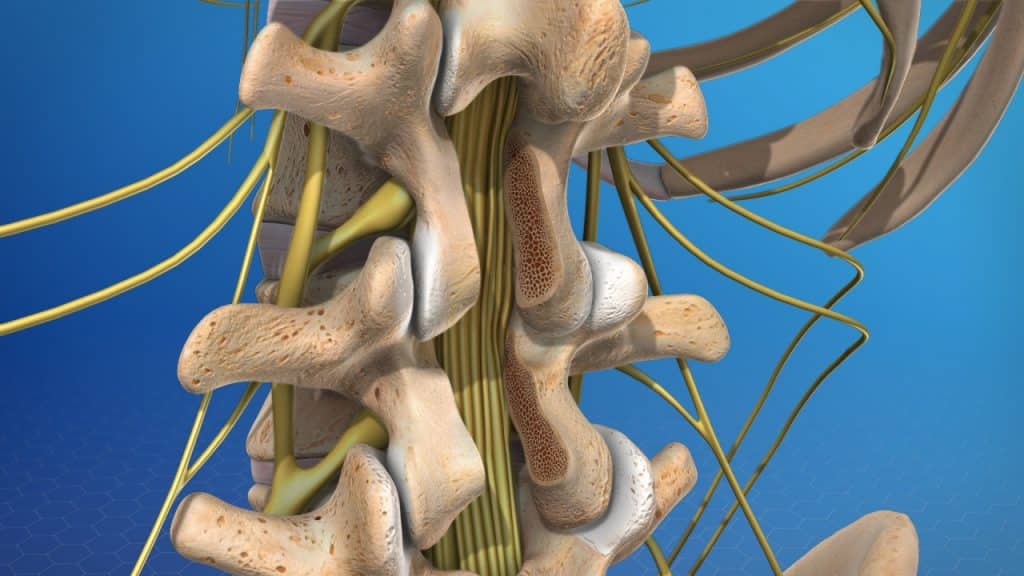 Laminectomy of lumbar spine