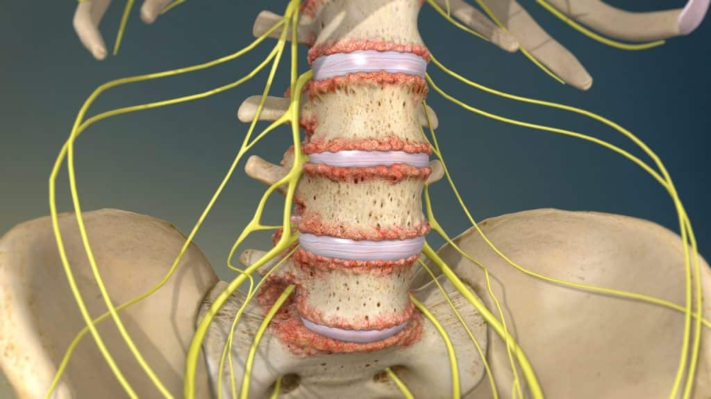 Οσφυϊκή μοίρα της σπονδυλικής στήλης με οστεόφυτα (οστεοαρθρίτιδα της σπονδυλικής στήλης)