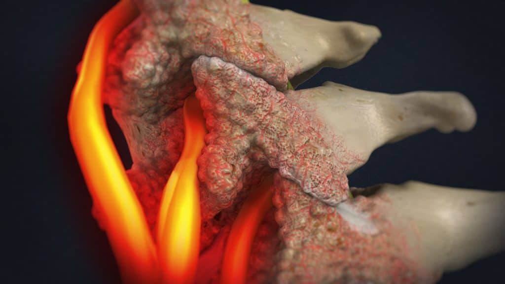Spinalstenose mit zervikaler Radikulopathie