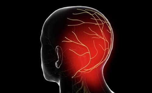 Occipital neuralgia