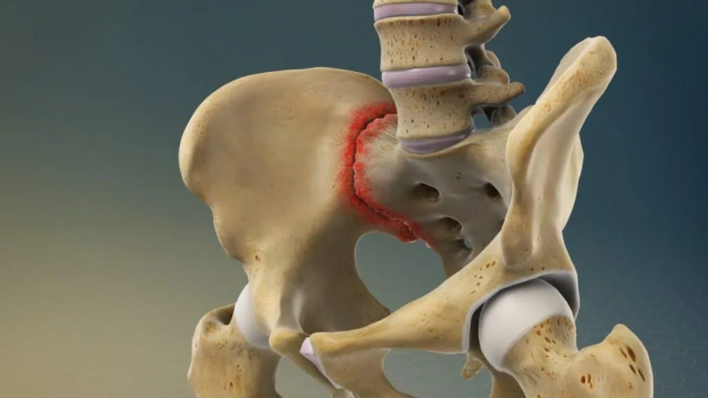 Sacroiliac joint pain (right side)