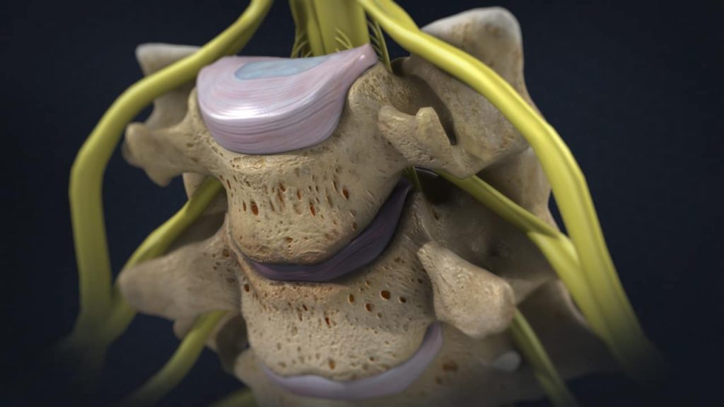 Дегенеративная Болезнь Диска