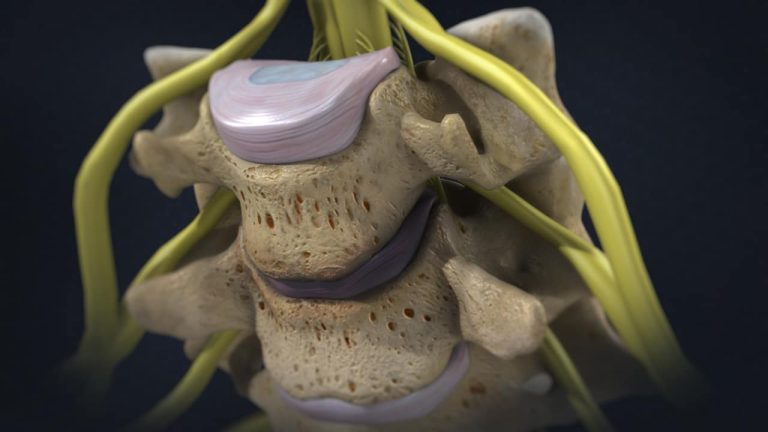 Degenerative disc in cervical spine