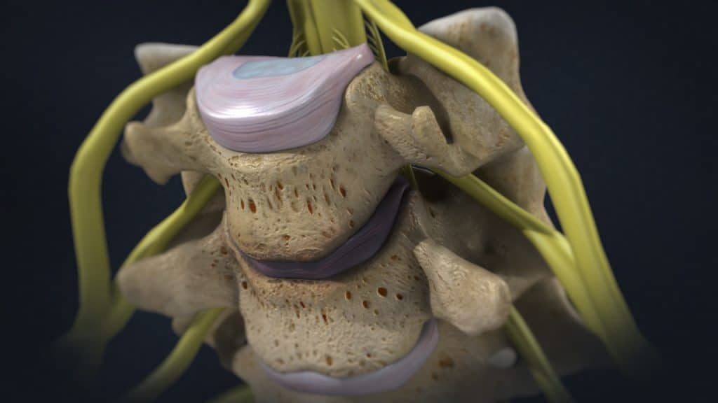 Degenerierte Bandscheibe der Halswirbelsäule