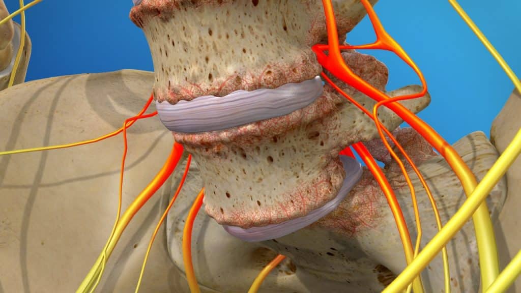 Spondylolisthesis mit gereizten Nervenwurzeln