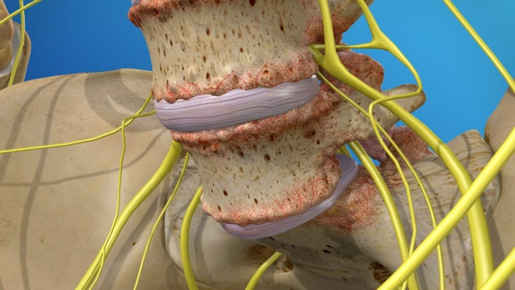 Degenerative Spondylolisthesis