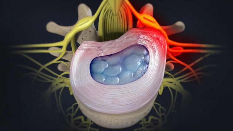 Lumbar herniated disc (top view)